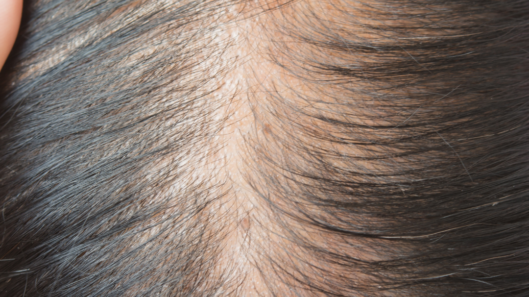 Why is My Hair Shedding? Understanding the Causes and Solutions